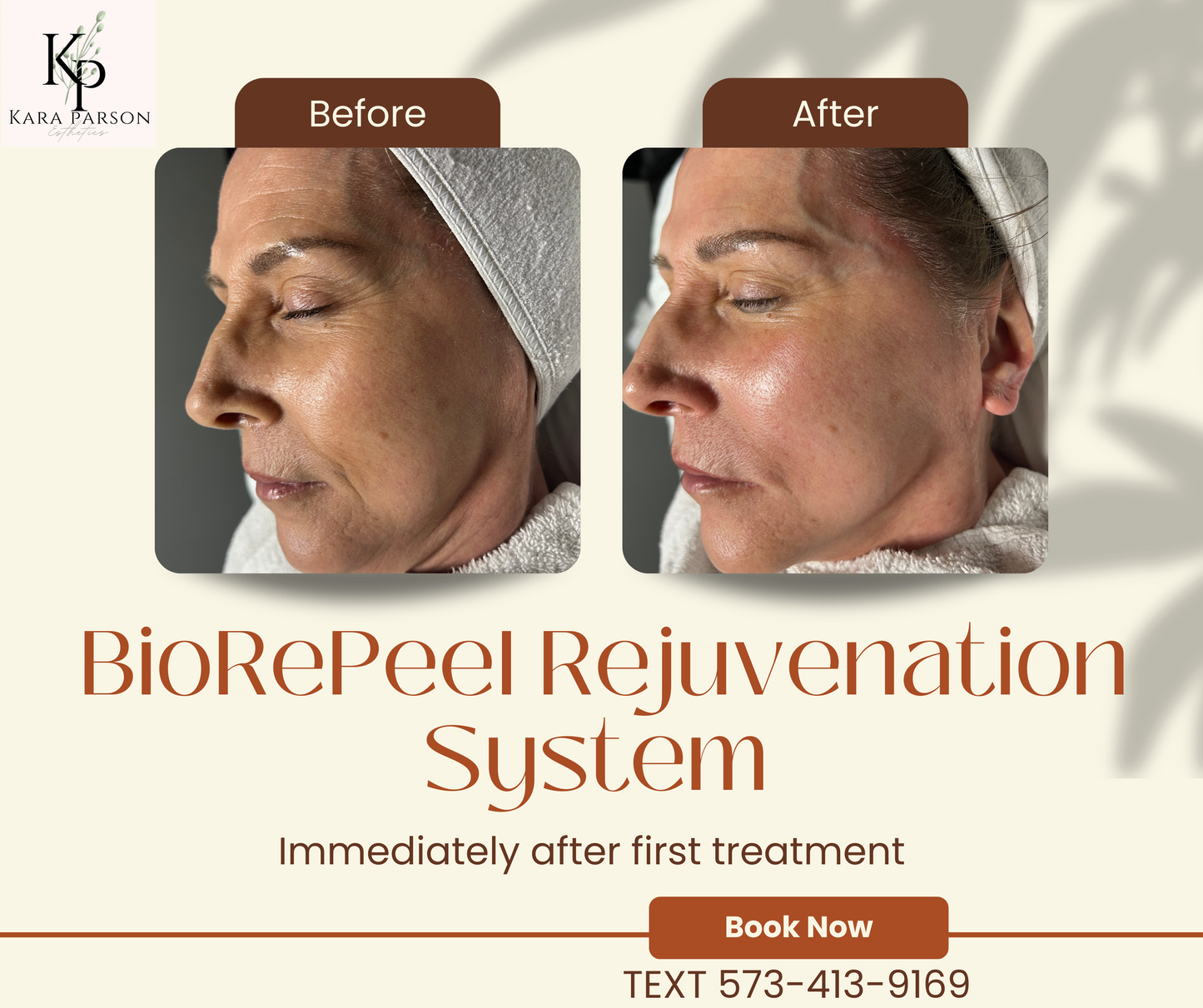BioRePeel Rejuvenation System MODEL